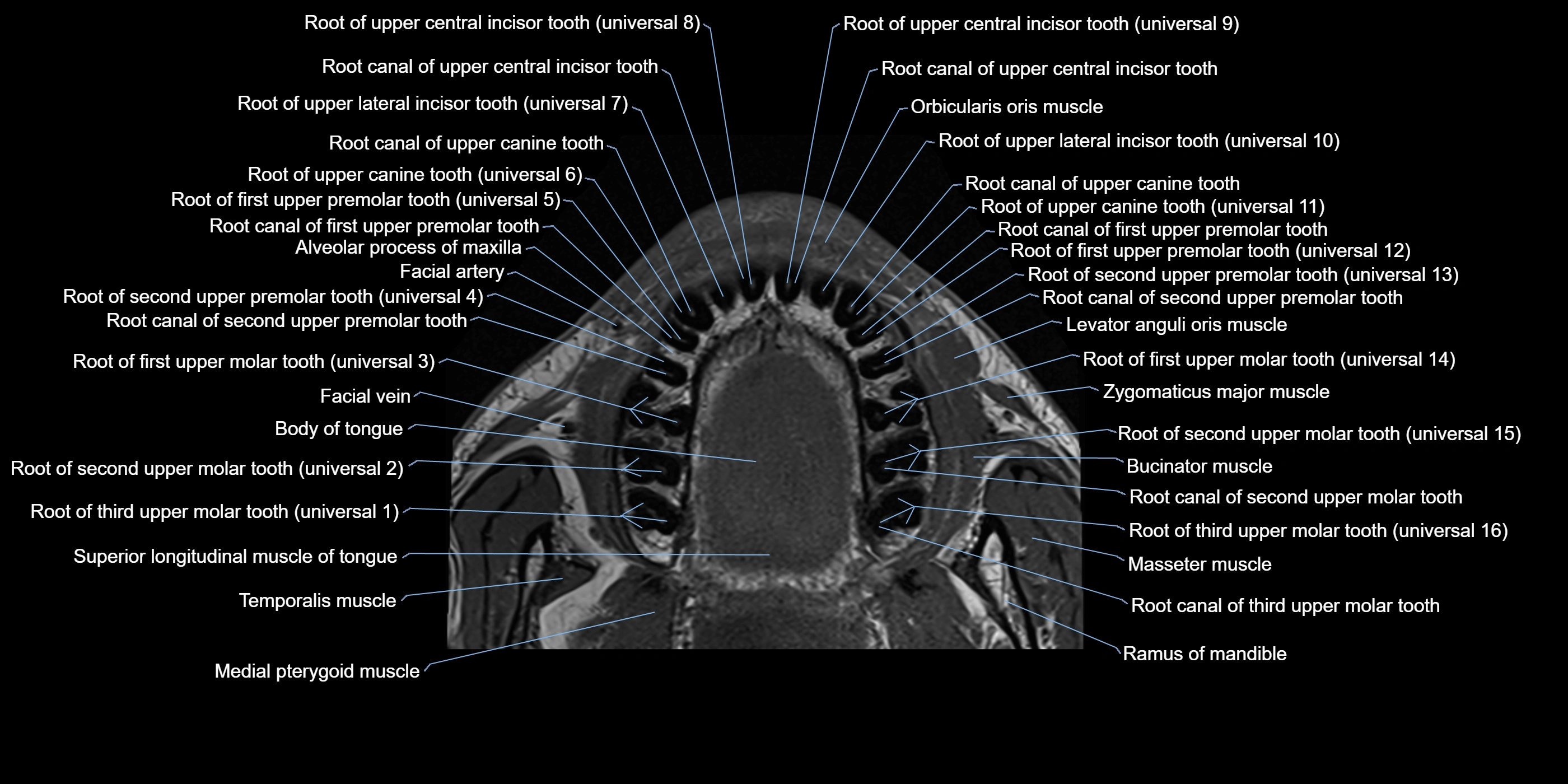 Dental MRI( tooth) axial labelled  cross sectional 3T anatomy -img-00003.webp